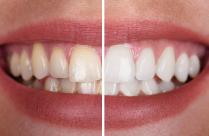 Clareamento Dental