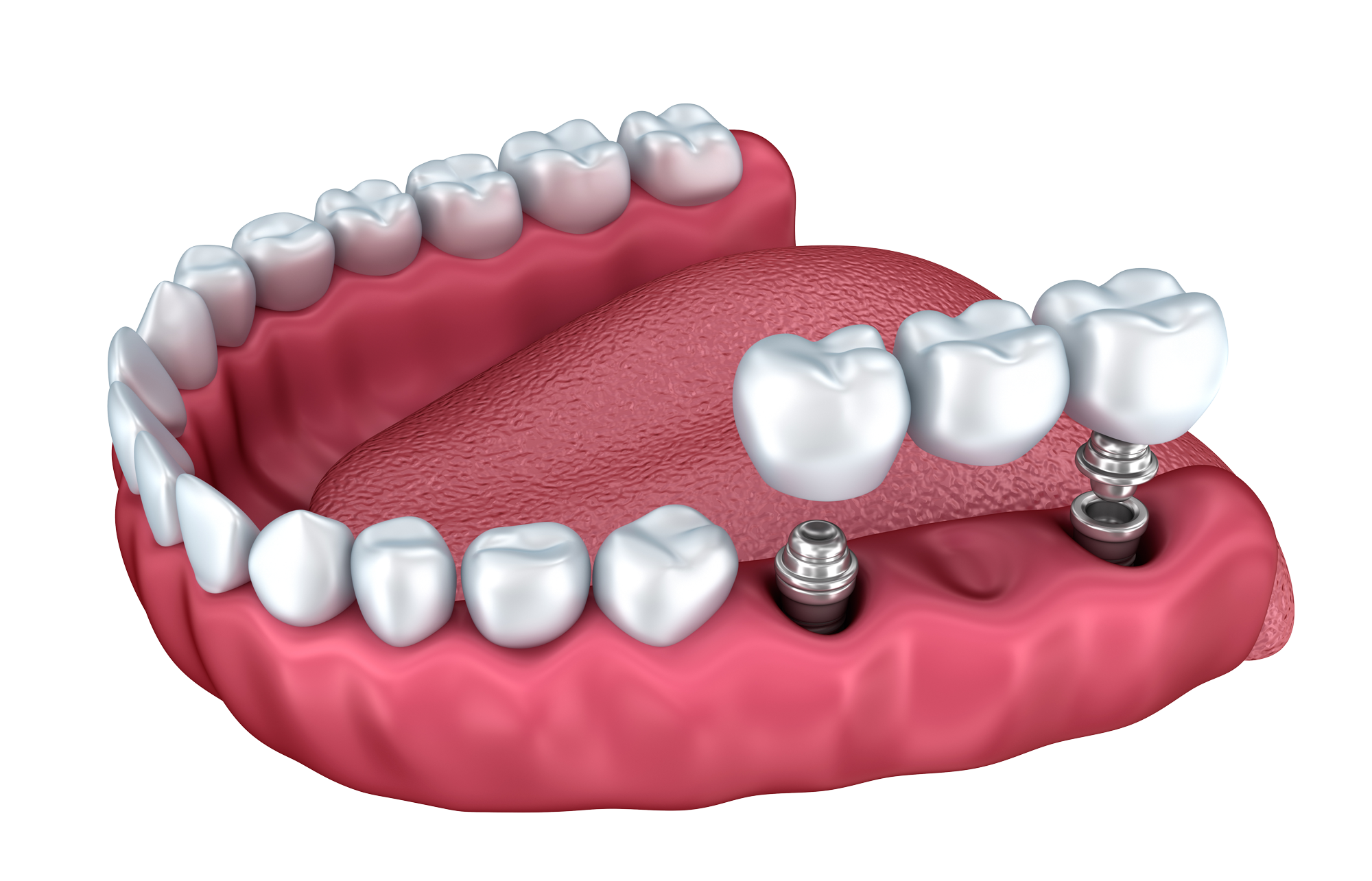 Implantes